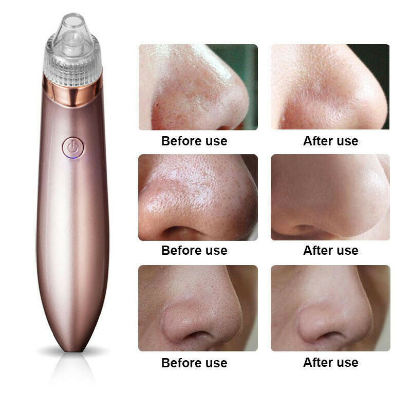 Electric Blackhead Vacuum Pore Cleaner Acne Pimple Remover Strong Suction Tool Electric Blackhead Remover Pore Vacuum Suction Diamond Dermabrasion Face Cleaner rechargeable